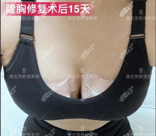 广州唐志荣隆胸术后