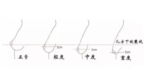 胸部下垂图