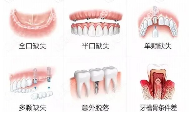湖州全口吸附性义齿价格