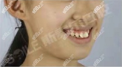 正畸范例