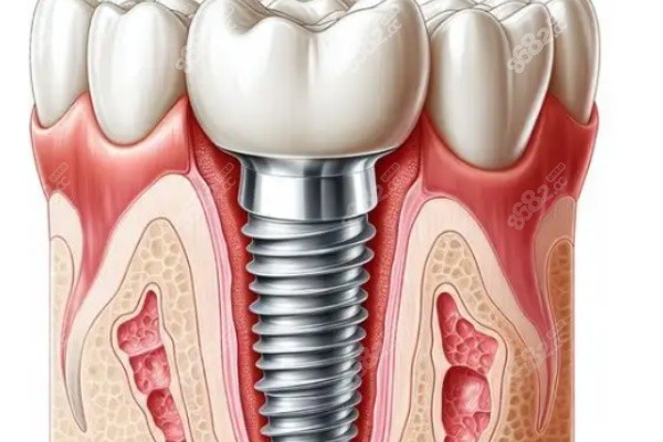 50到70岁种植牙医院哪家好