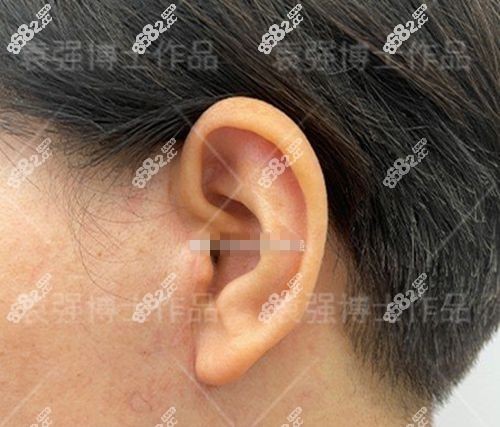 <!--<i data=20240705-sp></i>-->拉皮手术实例分享