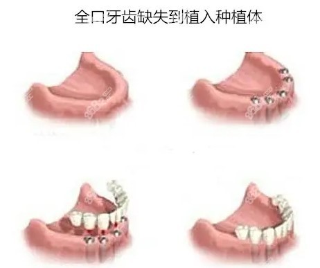 湖州全口假牙价格