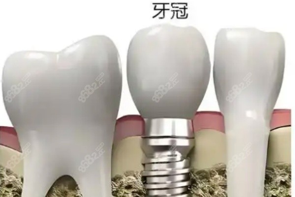 50到70岁种牙不同品牌种植牙价格哪个便宜