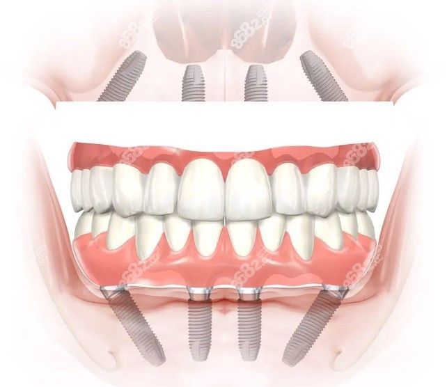 湖州全口种植牙多少钱