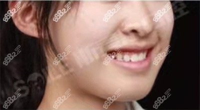 正畸后