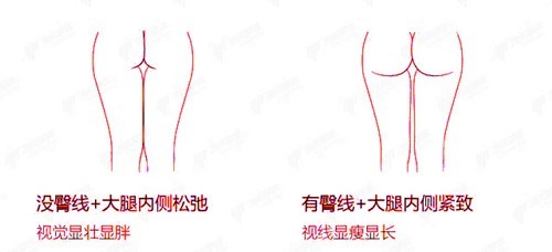 有无臀线对比