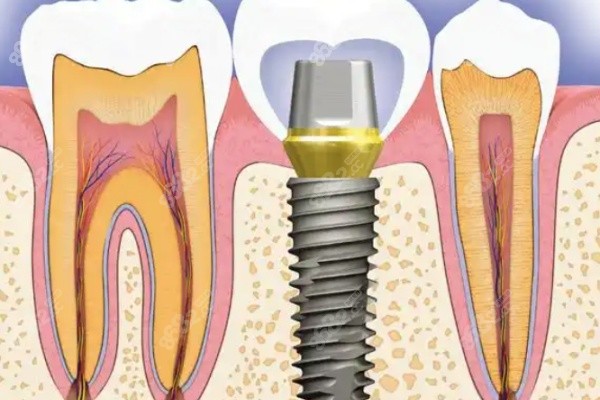 50到70岁种植牙医生哪个好