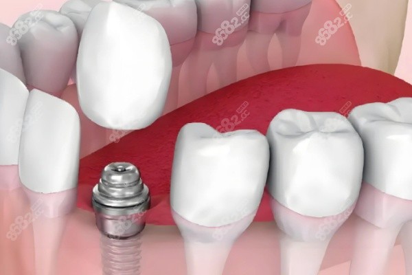 50到70岁各大医院种植牙价格详情