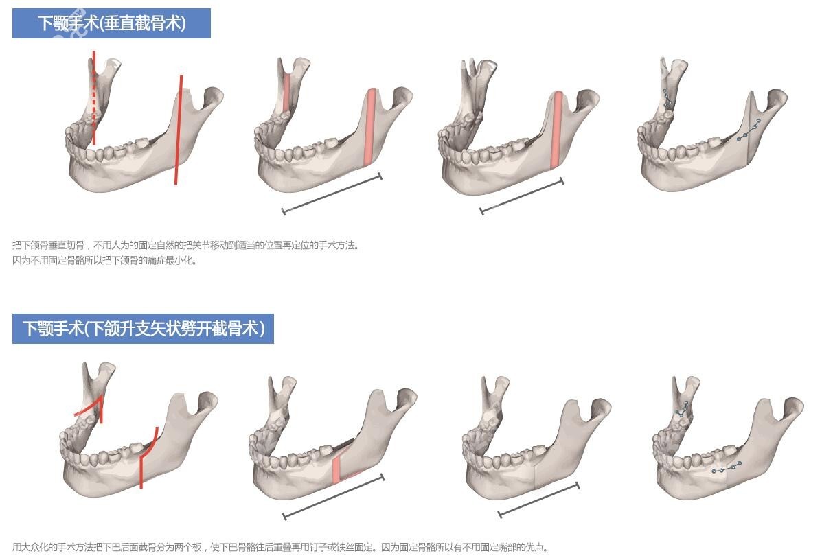 韩国一路美双鄂手术