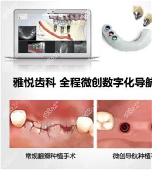 上海雅悦齿科数字化导航种植