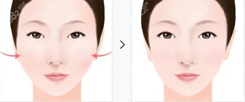 颧骨整形对比图.jpg