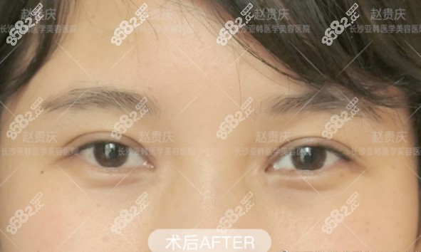 长沙亚韩整形医院双眼皮手术范例