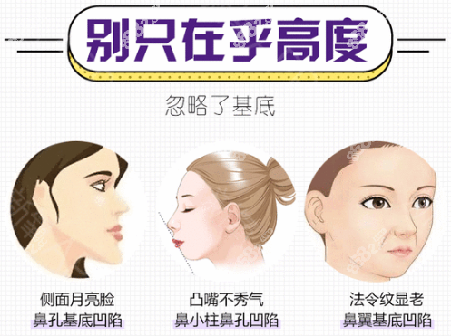 鼻基底凹陷对面部的影响