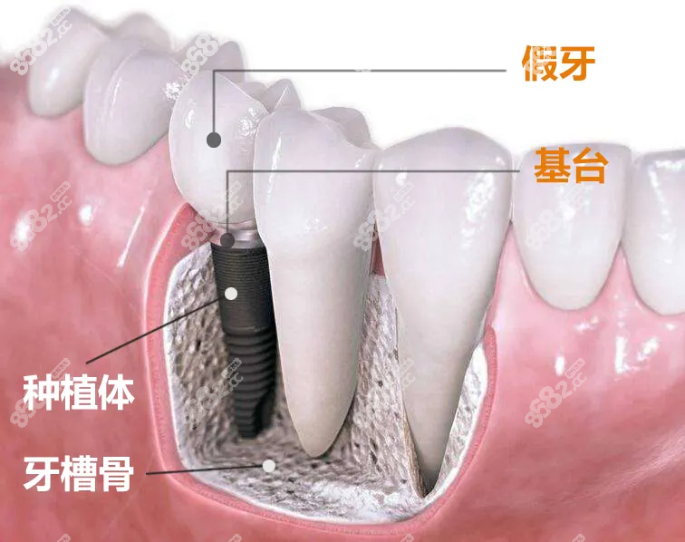 種植牙總費(fèi)用的構(gòu)成