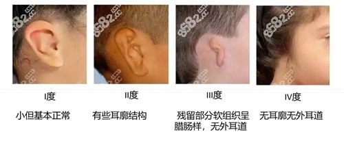 小耳畸形的几个等级