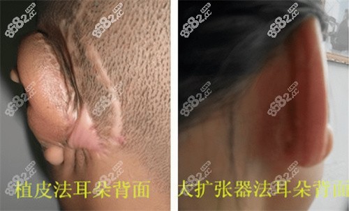 植皮法与全包法小耳再造的术后疤痕对比