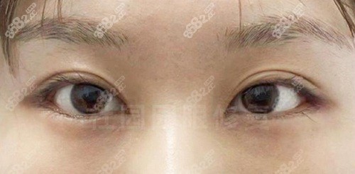 师丽丽修复双眼皮怎么样？