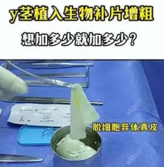 男性生物補(bǔ)片延長(zhǎng)增粗好嗎