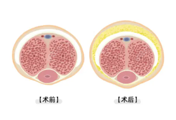 男性生物補(bǔ)片延長(zhǎng)增粗
