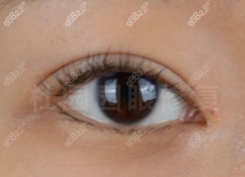 师丽丽修复双眼皮怎么样？