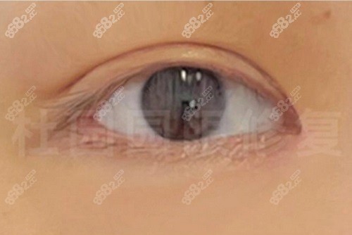 师丽丽修复双眼皮怎么样？