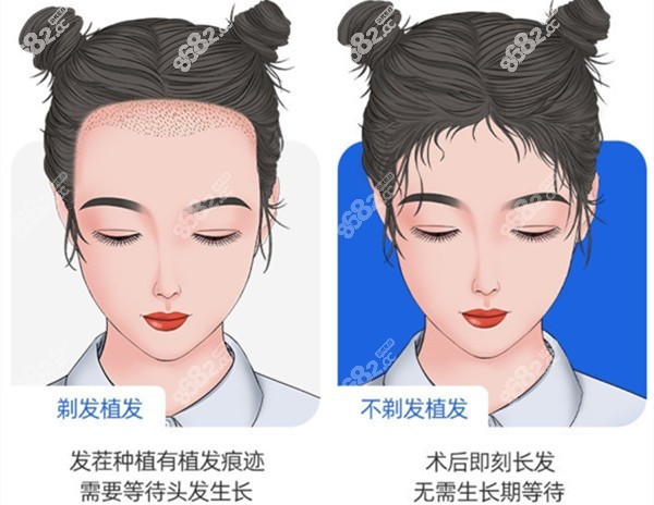 我去碧蓮盛花6萬做了植發(fā)的經(jīng)歷