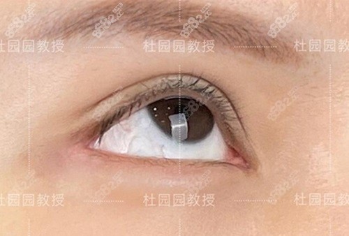 师丽丽修复双眼皮怎么样？