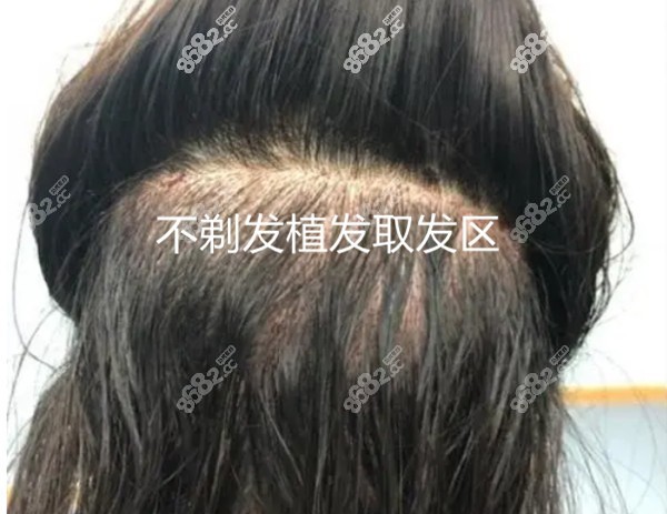 我去碧蓮盛花6萬做了植發(fā)的經(jīng)歷