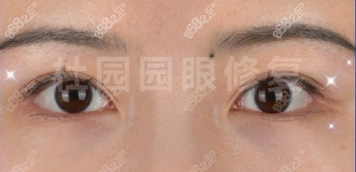 师丽丽修复双眼皮怎么样？