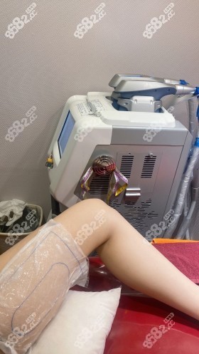韩国365mc的冷冻脂肪治疗图示