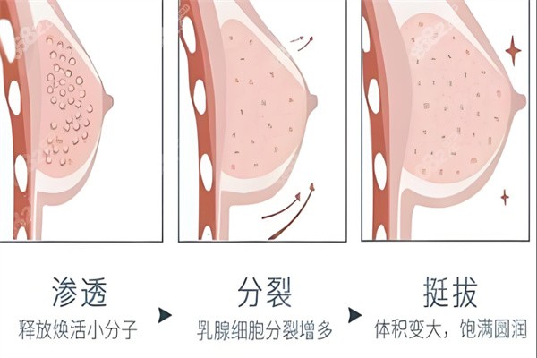胸部下垂整形价