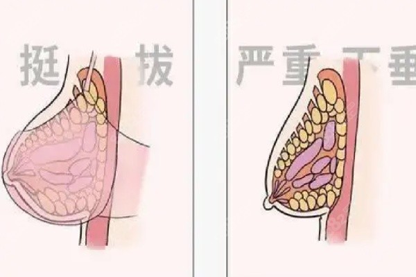 胸部下垂整形医院哪个比较好：资质与技术的双重考量