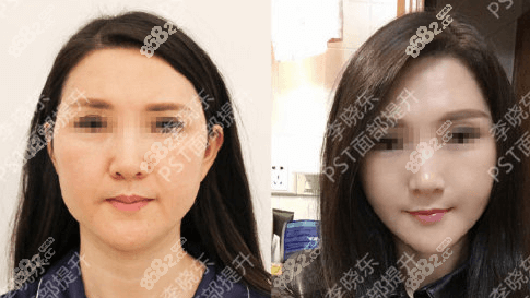 <!--<i data=20240705-sp></i>-->瑞丽李晓东PST面部提升效果好吗？真人案例参考