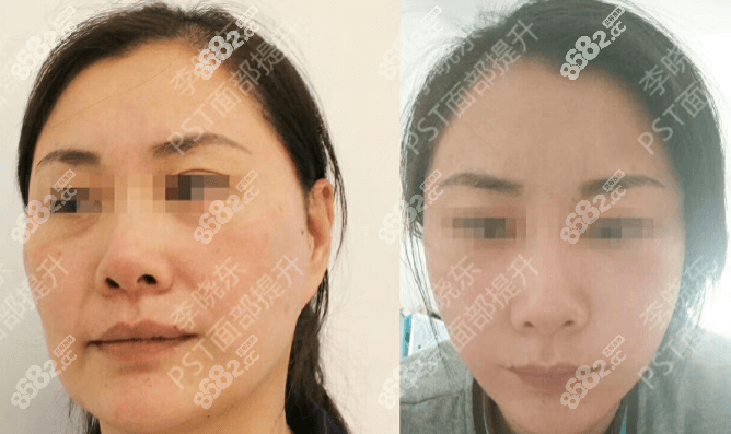 <!--<i data=20240705-sp></i>-->瑞丽李晓东PST面部提升案例效果参考