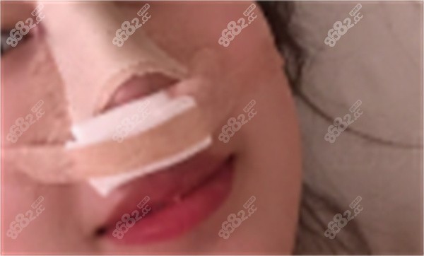 西安隆鼻價格 2025