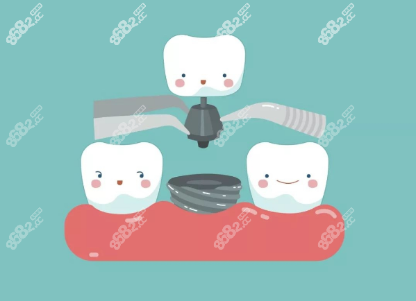 意大利bb 3P种植体价格 意大利bb 3P种植体价格