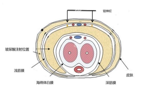 注射玻尿酸填充男性增大增粗