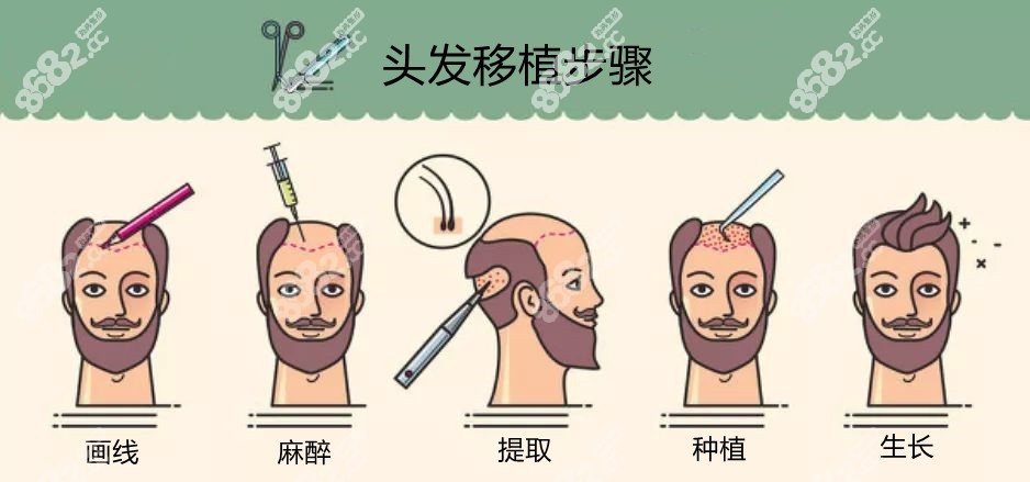 土耳其植发