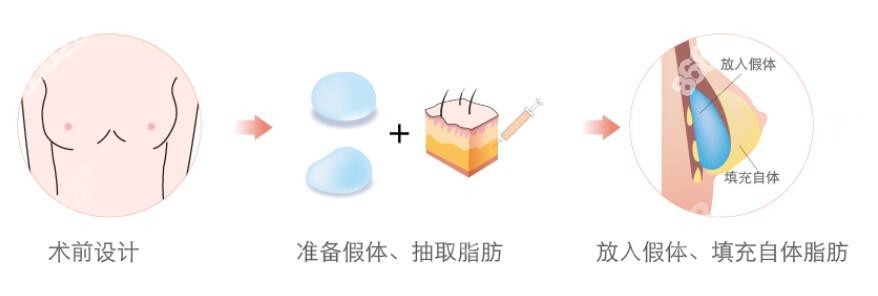 东莞缔美<!--<i data=20240705-sp></i>-->医生复合隆胸过程