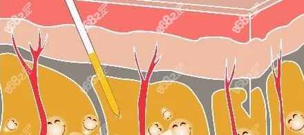 上海美莱做吸脂示意图