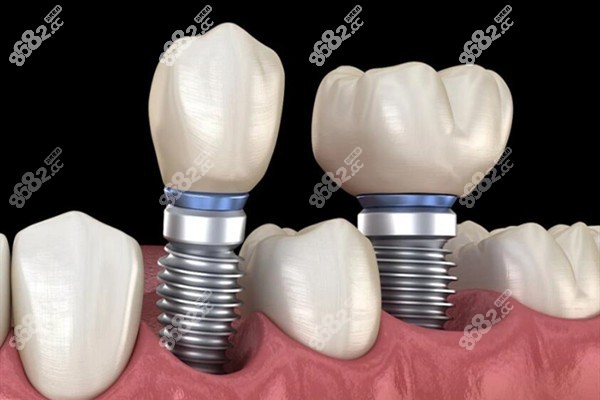 種植牙