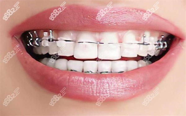 牙齒矯正