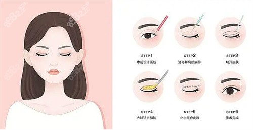 长沙张娇娇双眼皮费用