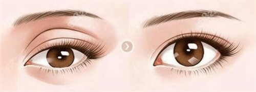 长沙张娇娇双眼皮费用