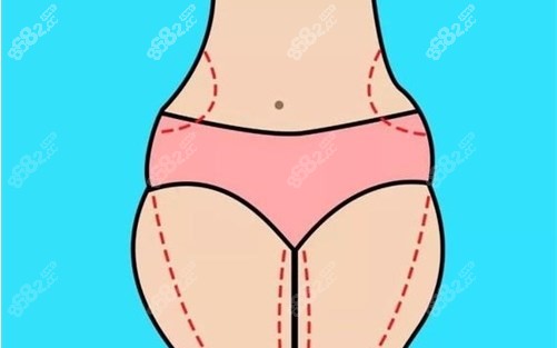 3s人鱼体雕和腰腹环吸