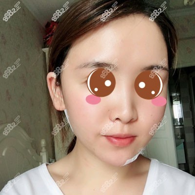 在怡脂整形做完面部吸脂后的效果