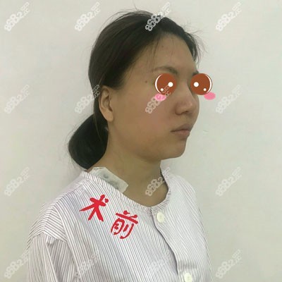 到成都怡脂做面吸前顾客的面部
