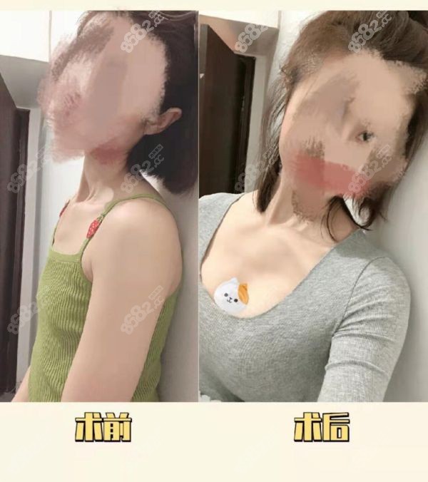 栗勇醫(yī)生隆胸在國內(nèi)排第幾