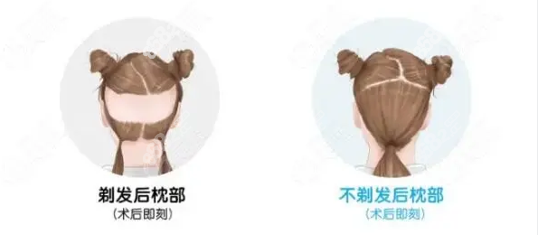 完全不剃发种植技术